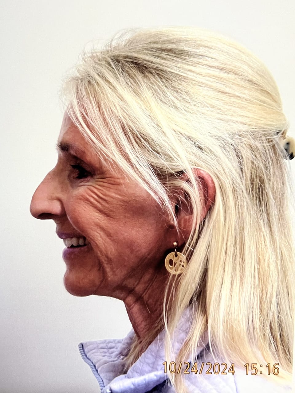 Case Study 257 — before and after