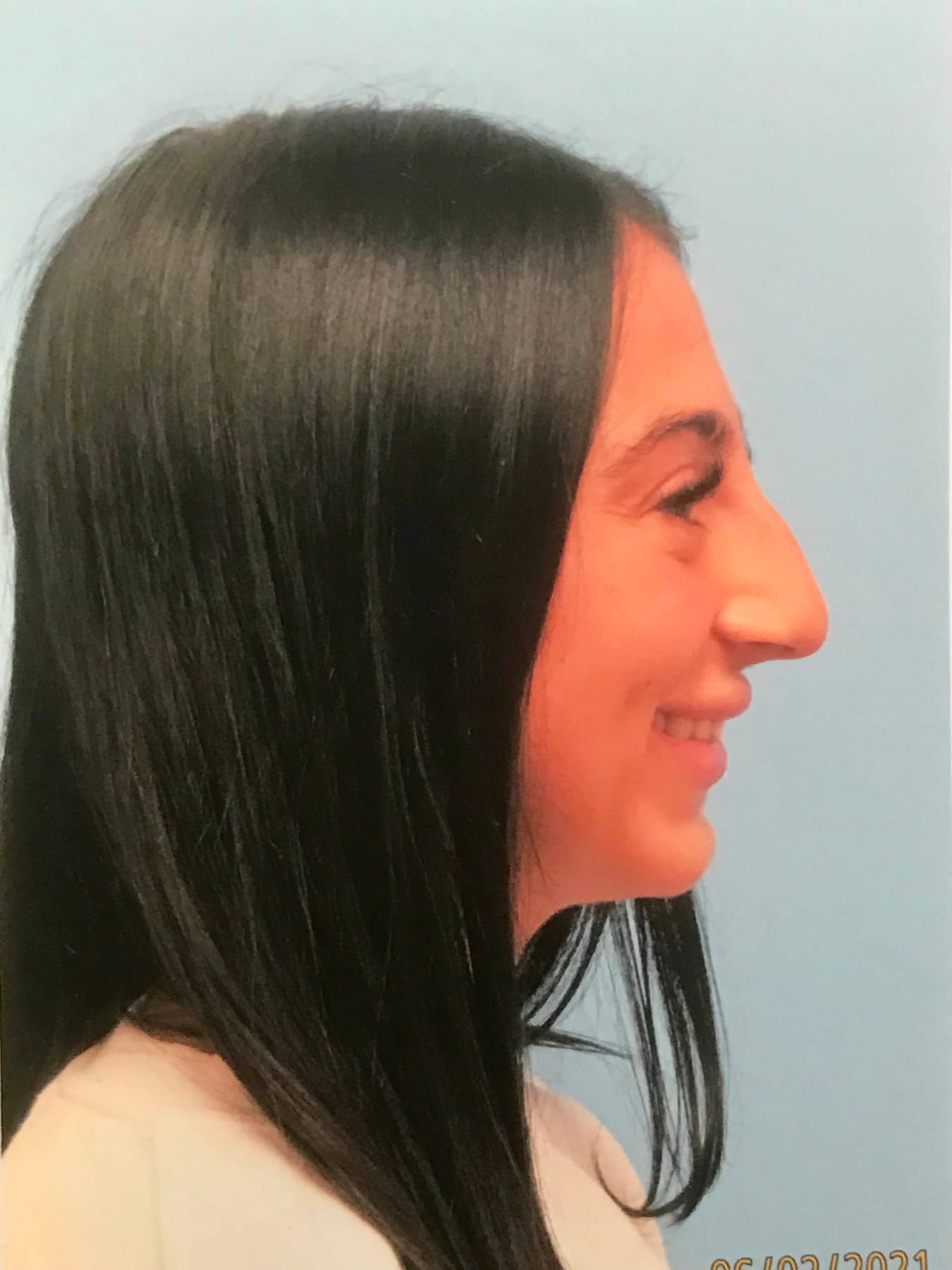 Case Study 27 — before and after