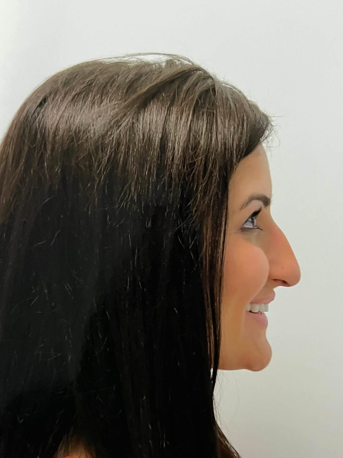 Case Study 44 — before and after