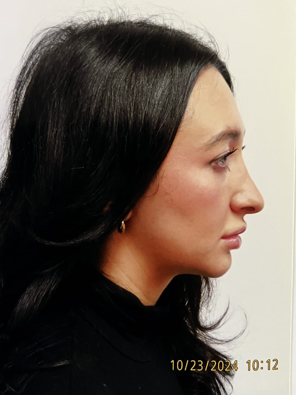 Case Study 255 before