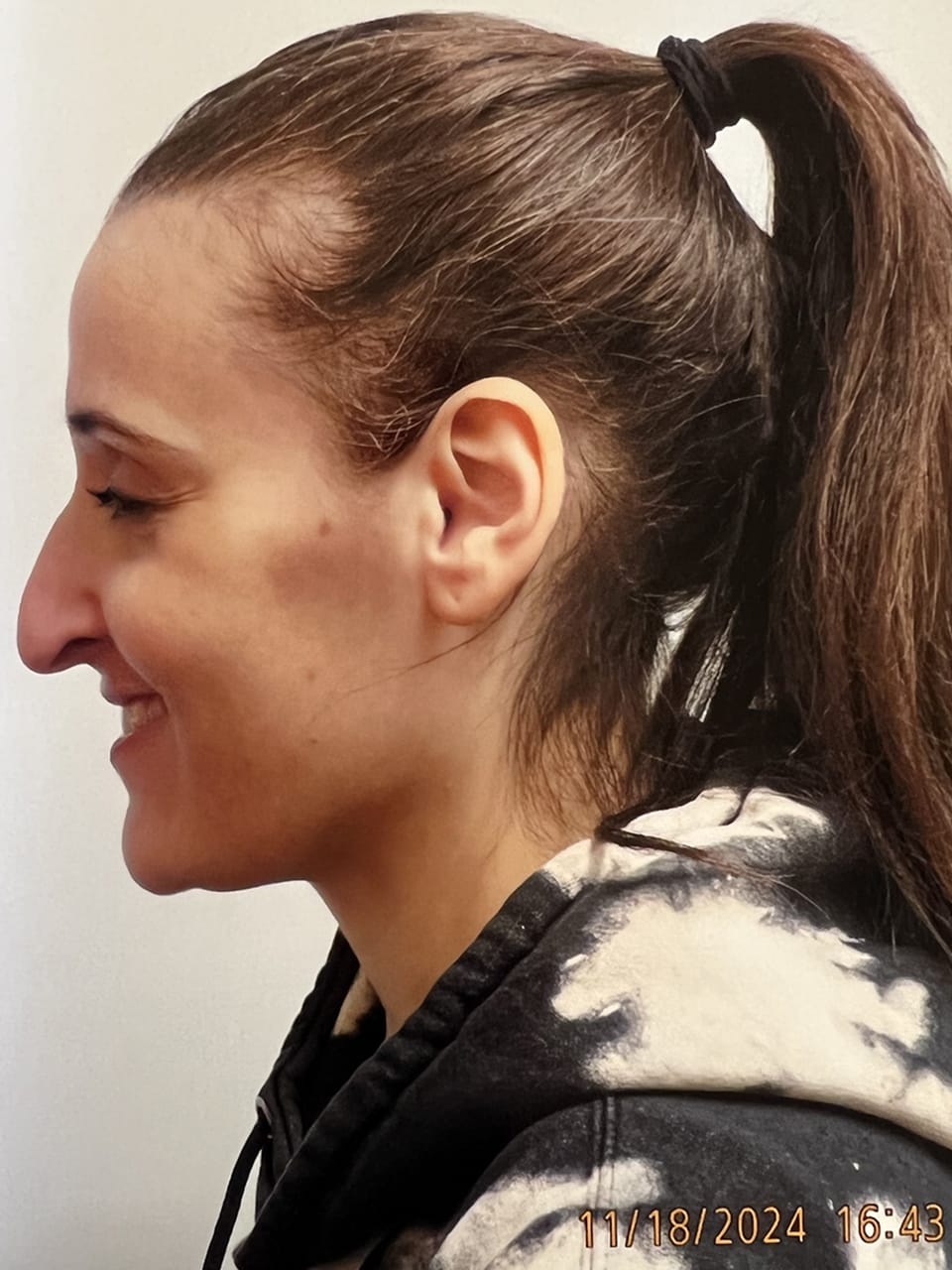 Case Study 251 — before and after