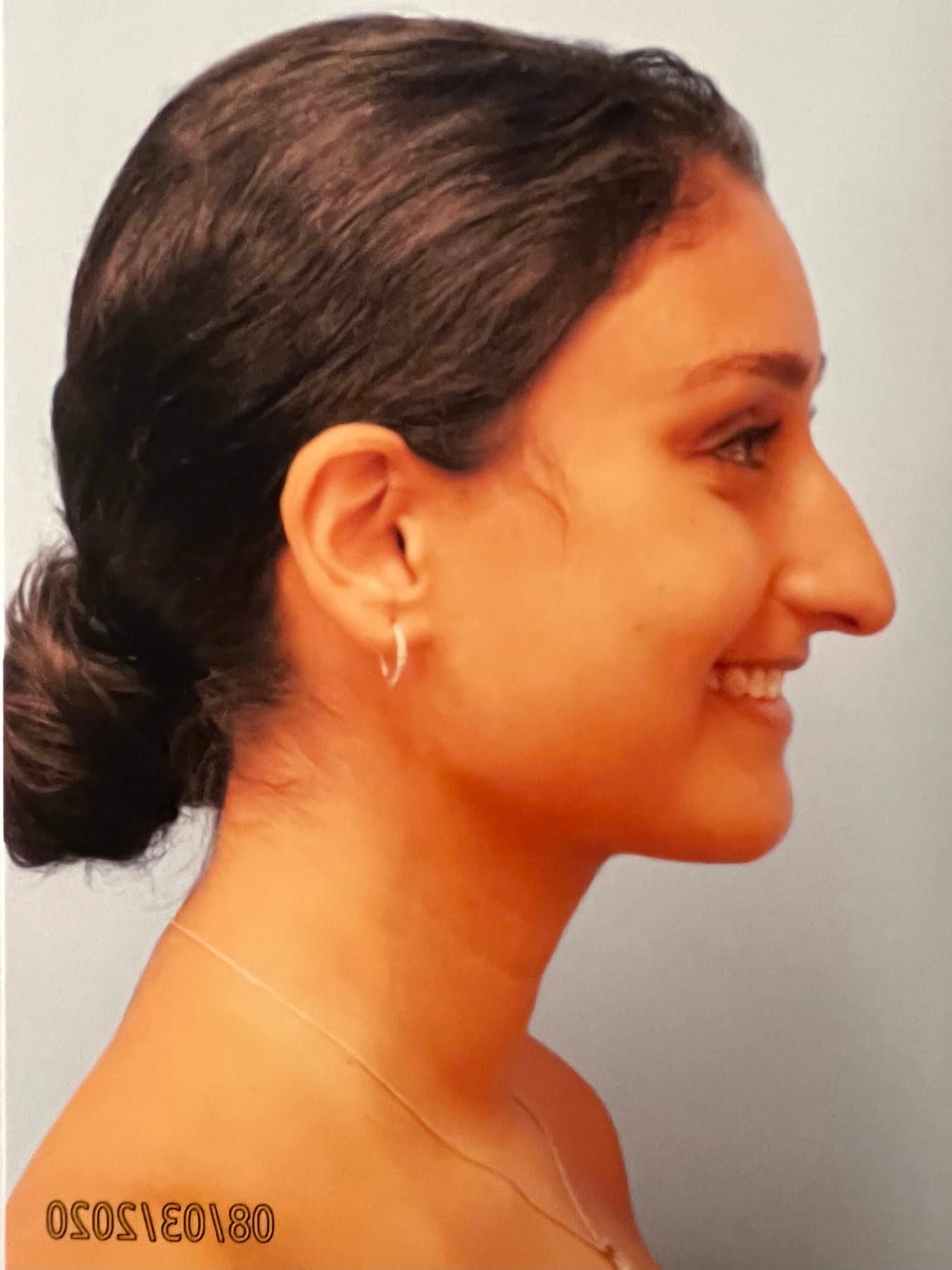Case Study 1 — before and after