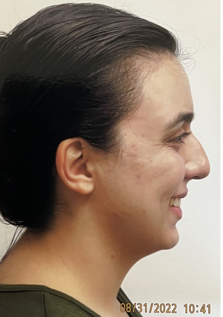 Case Study 155 — before and after