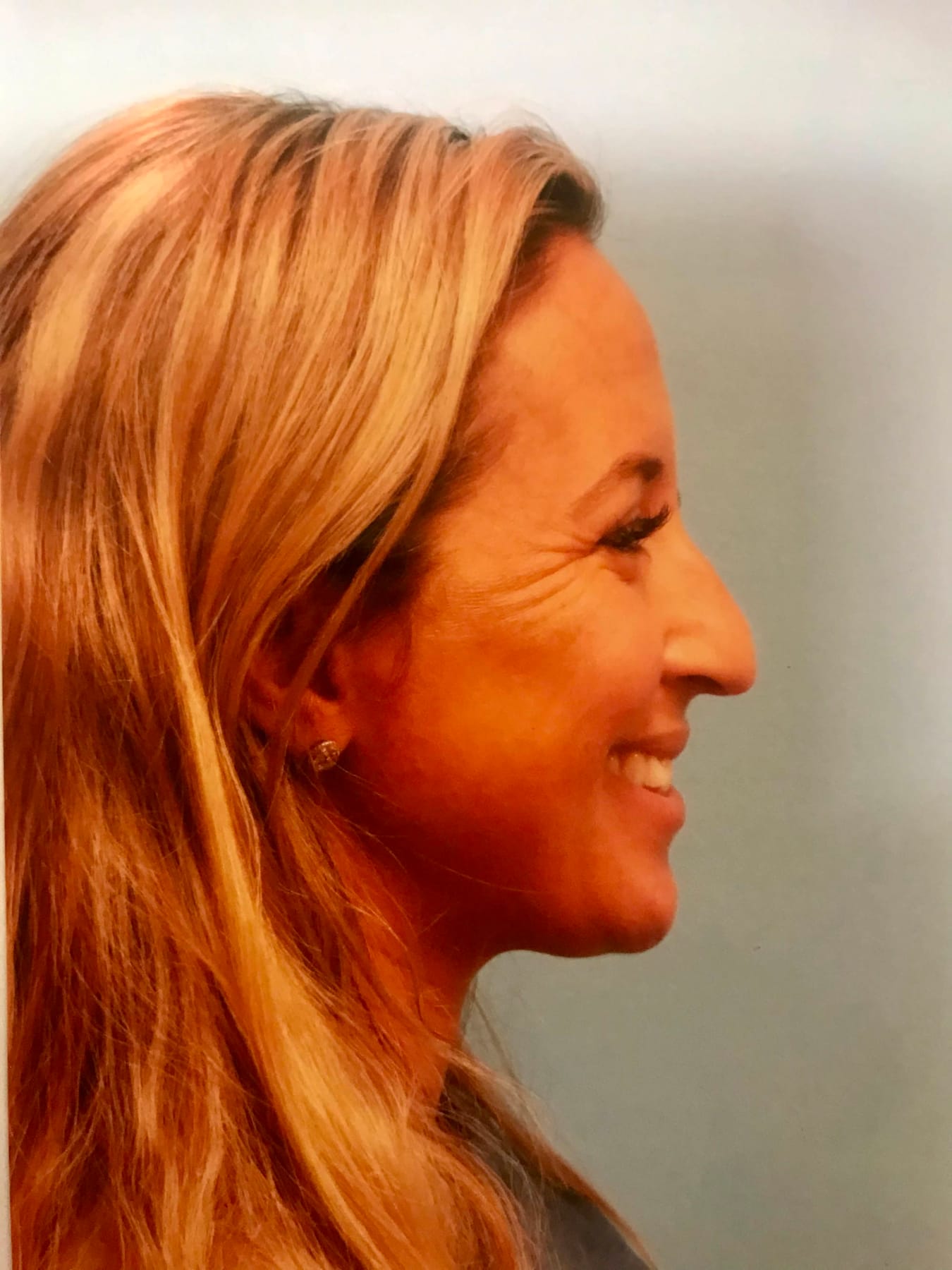 Case Study 4 — before and after
