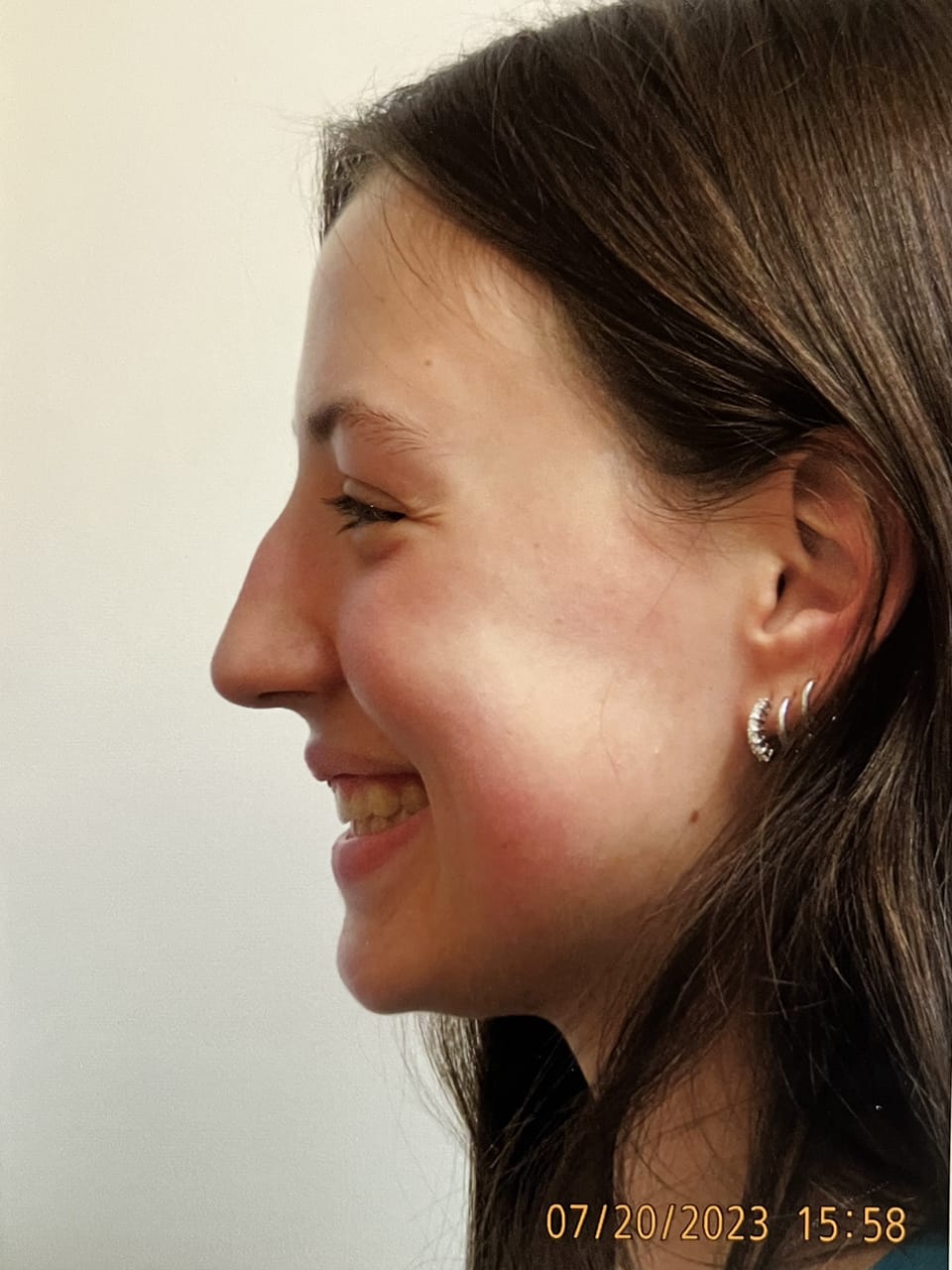 Case Study 241 — before and after