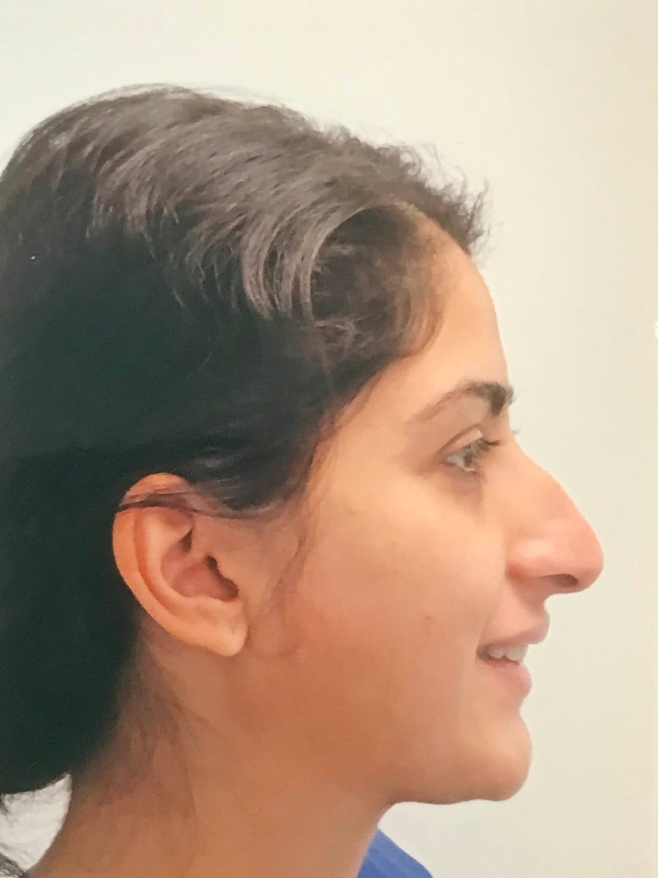 Case Study 15 — before and after