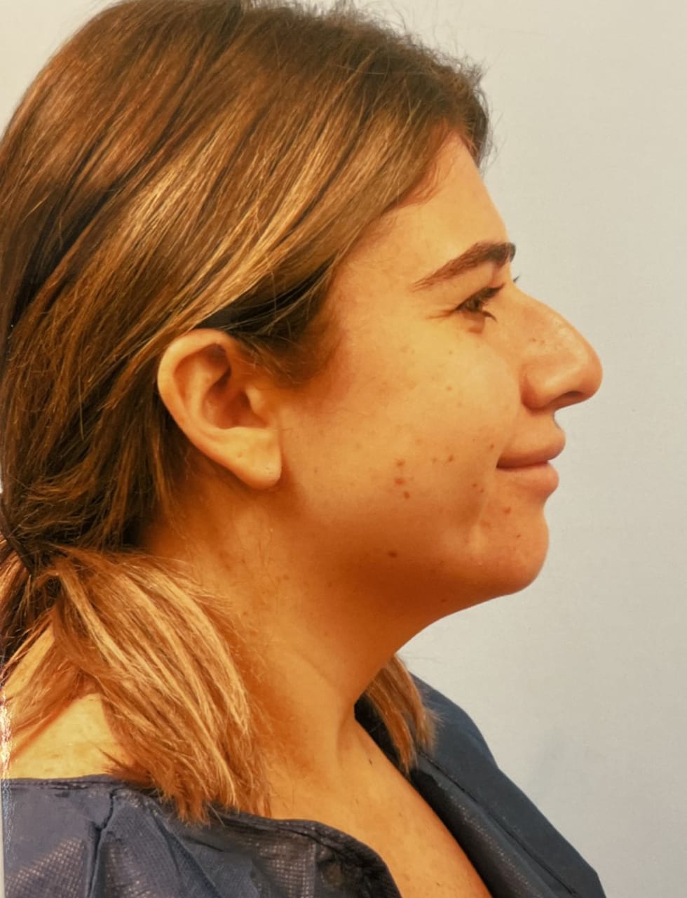 Case Study 55 — before and after