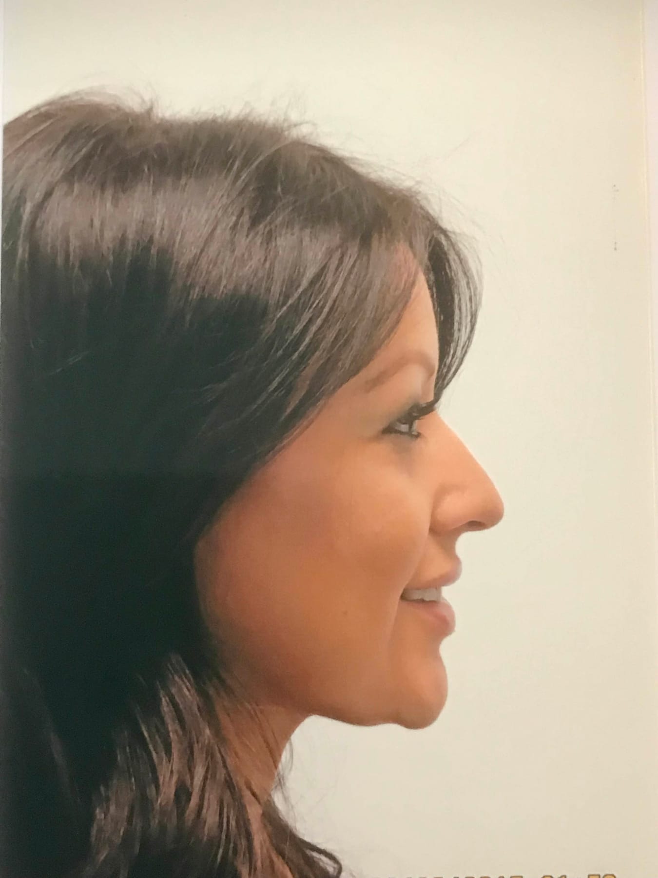 Case Study 37 — before and after