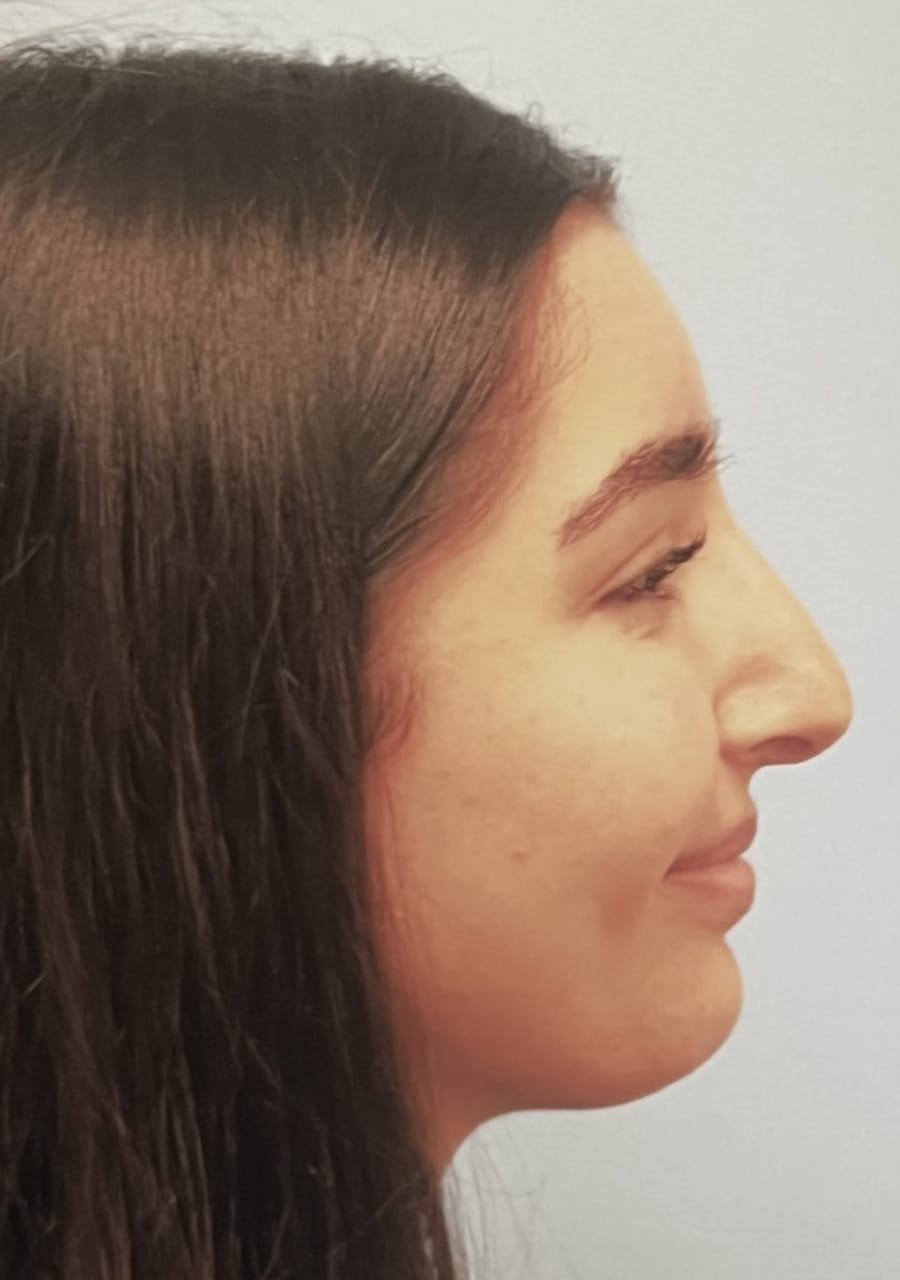 Case Study 87 — before and after