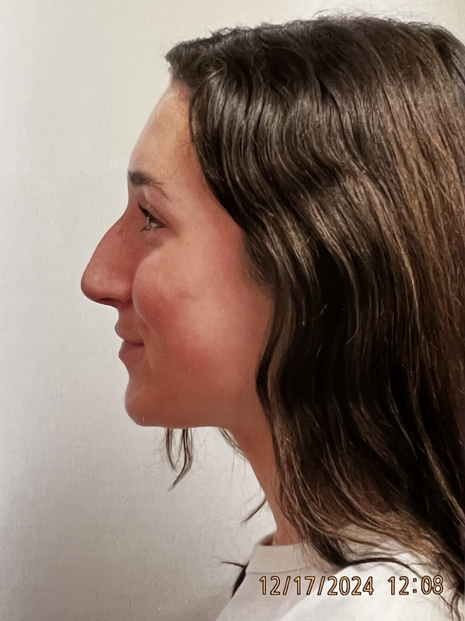 Case Study 252 — before and after