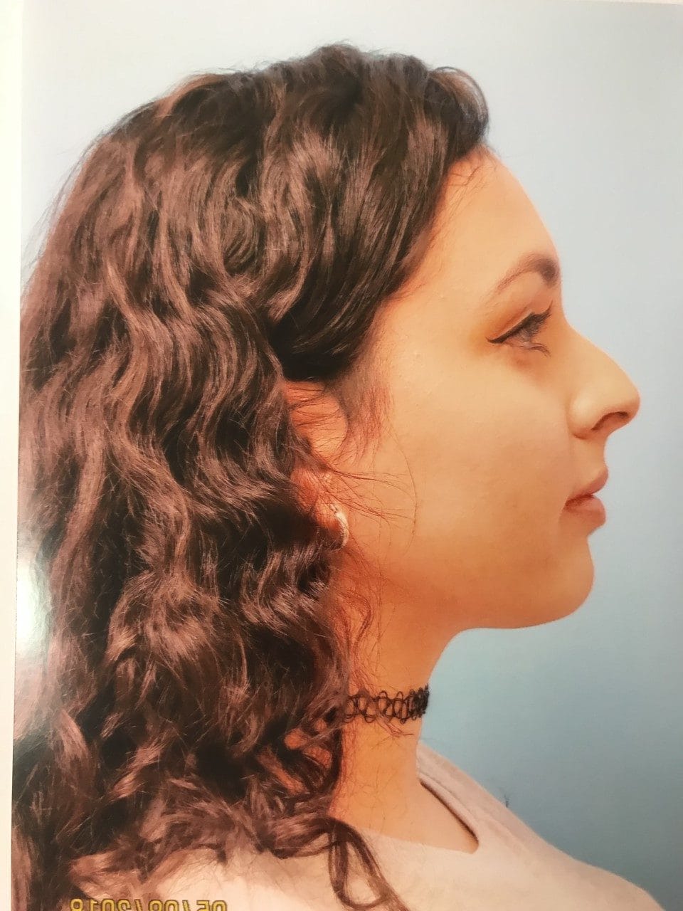 Case Study 16 — before and after