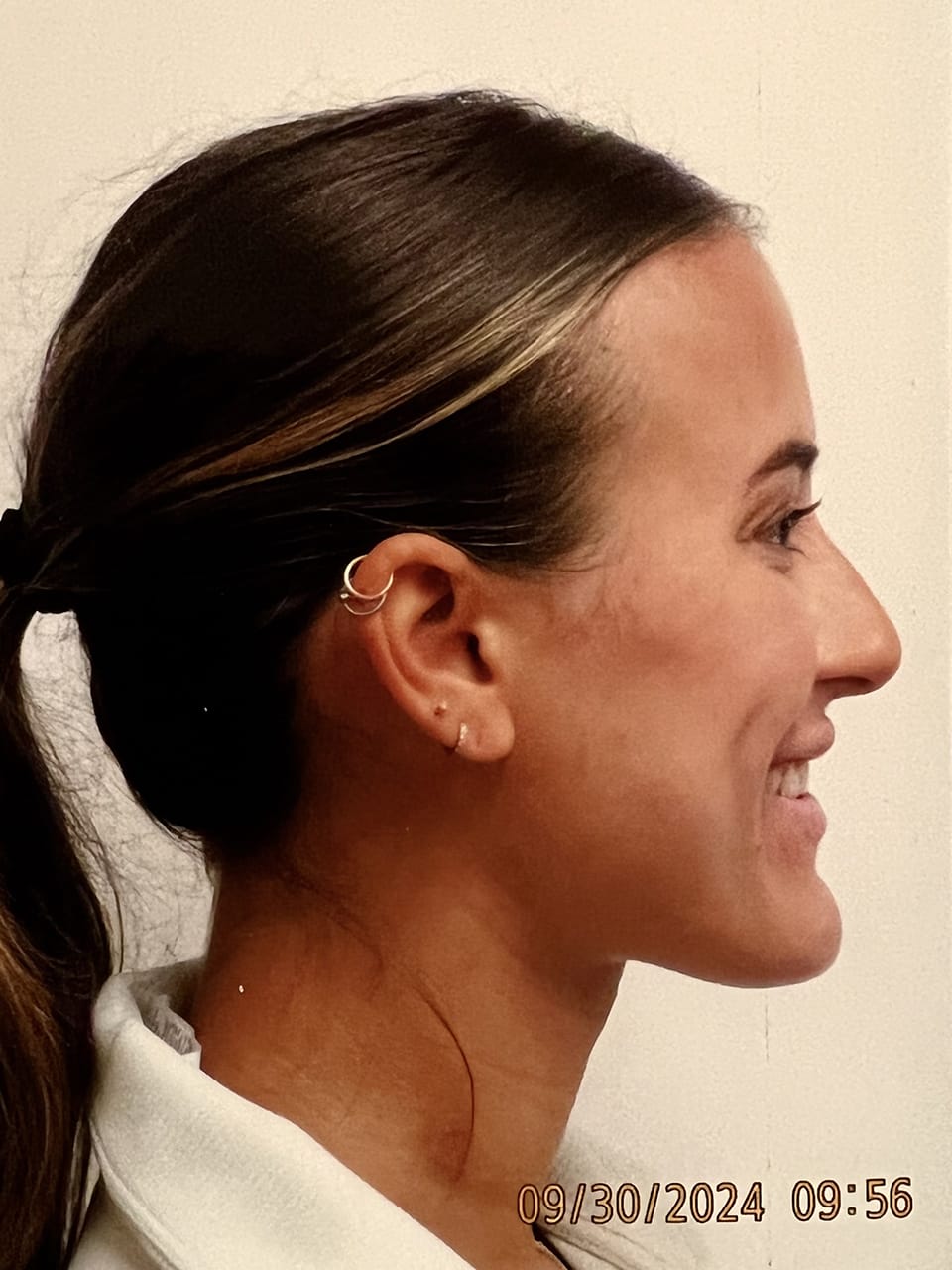 Case Study 245 — before and after