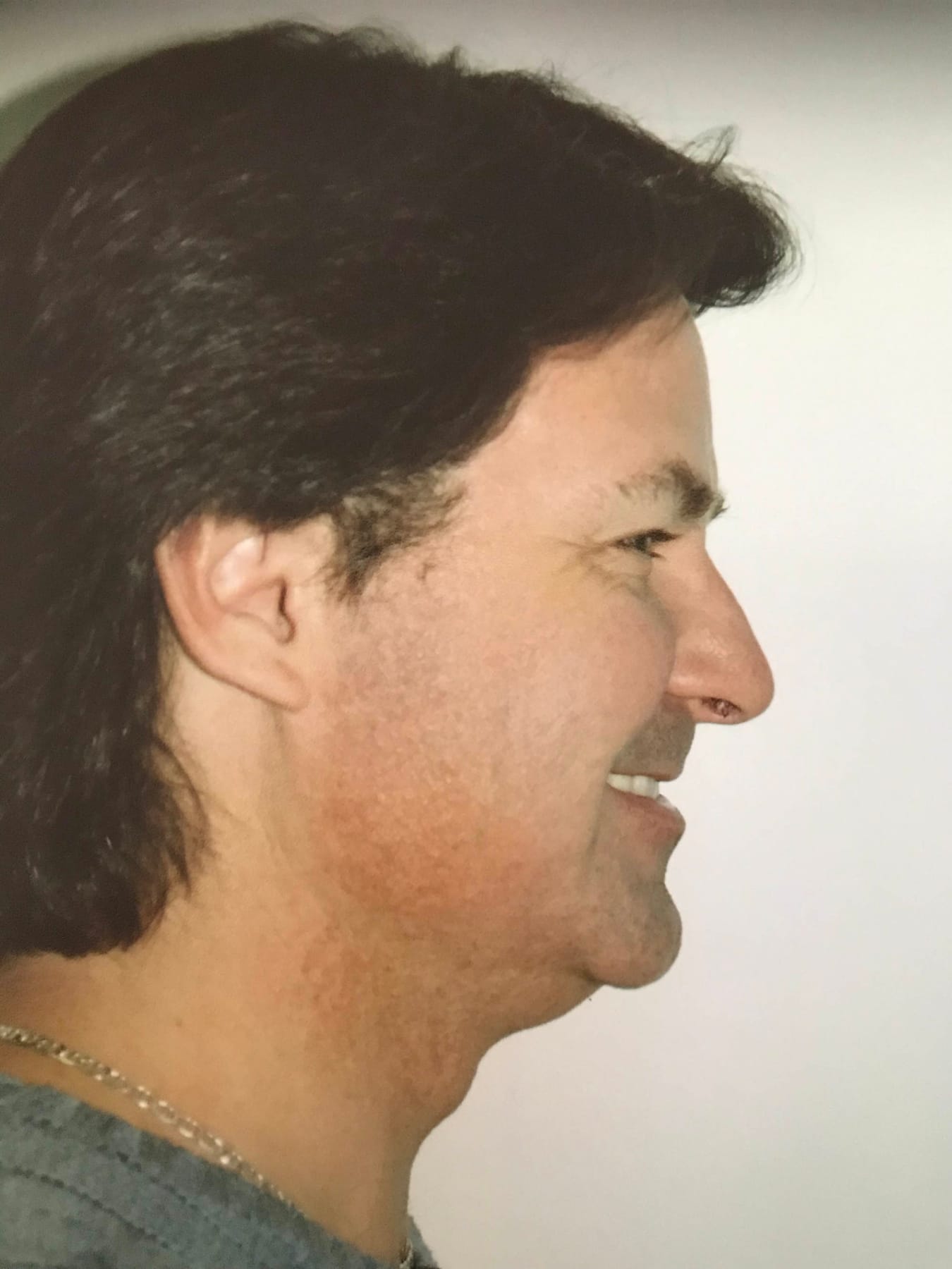 Case Study 41 — before and after