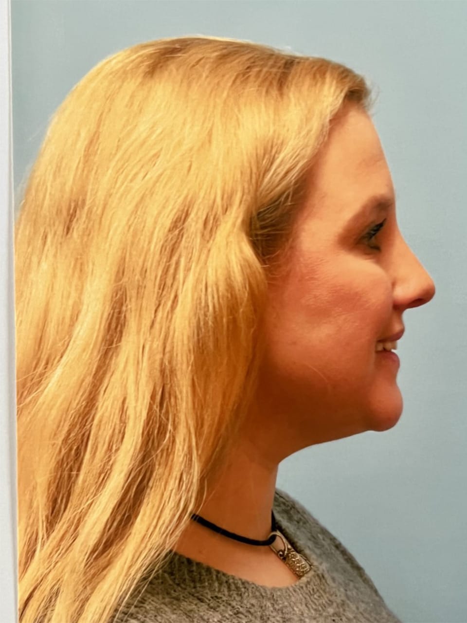 Case study 50 after