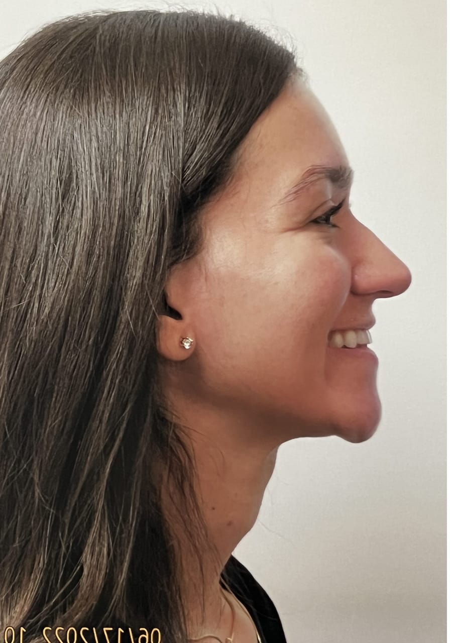 Case Study 153 — before and after