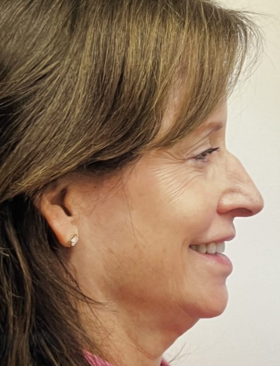 Case Study 74 — before and after