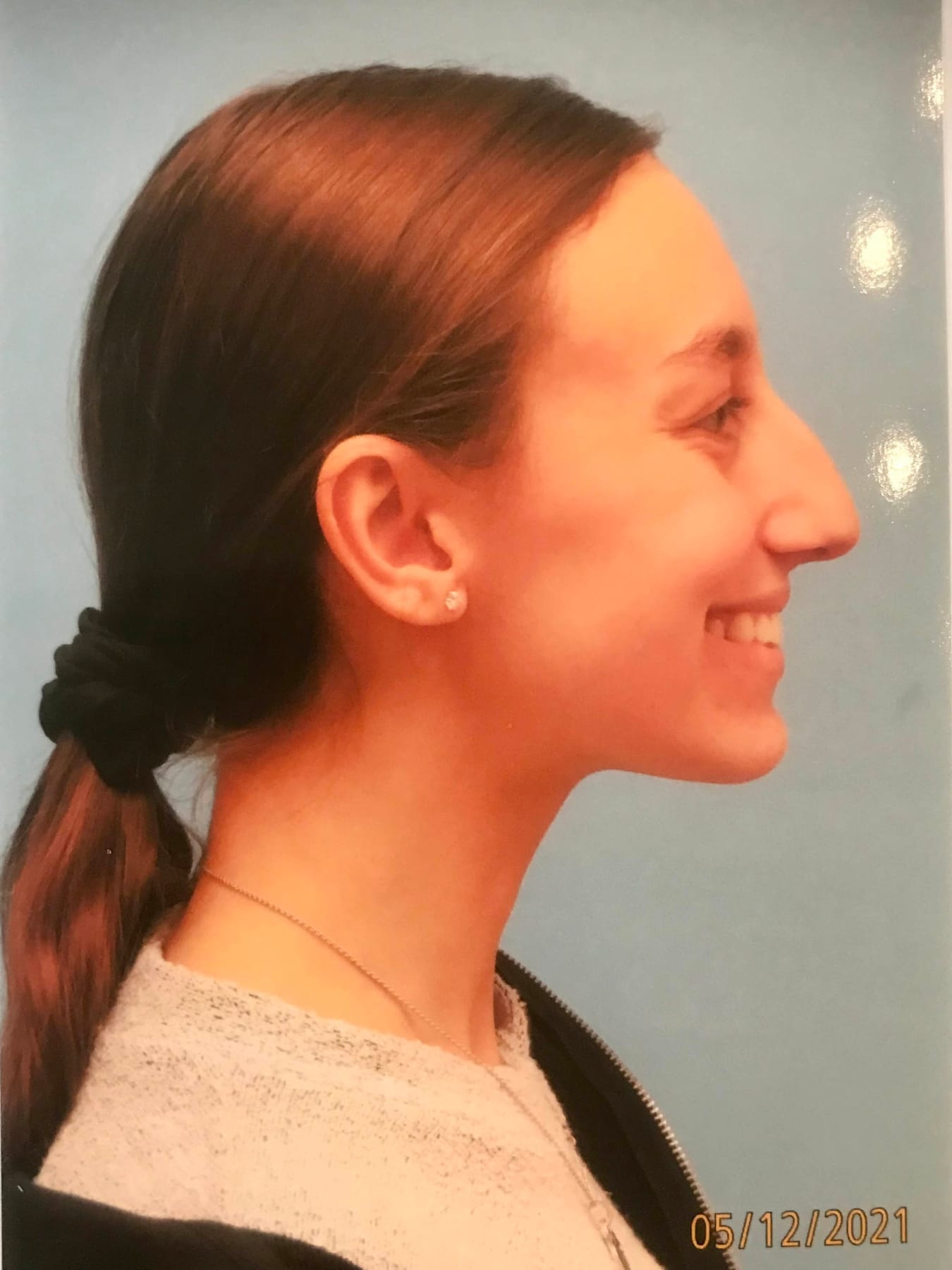 Case Study 43 — before and after