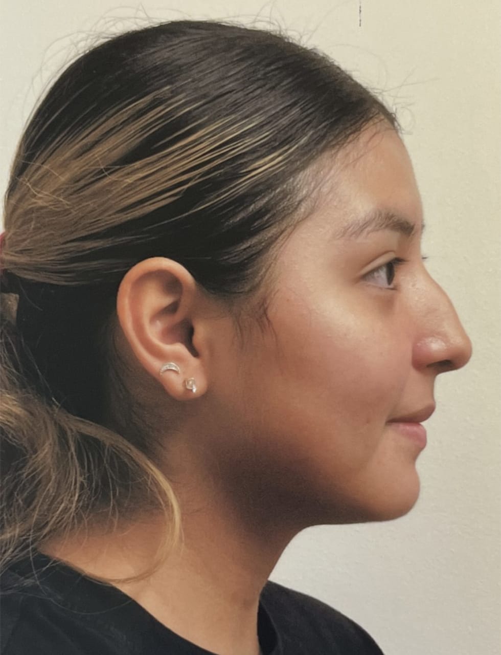 Case Study 72 — before and after