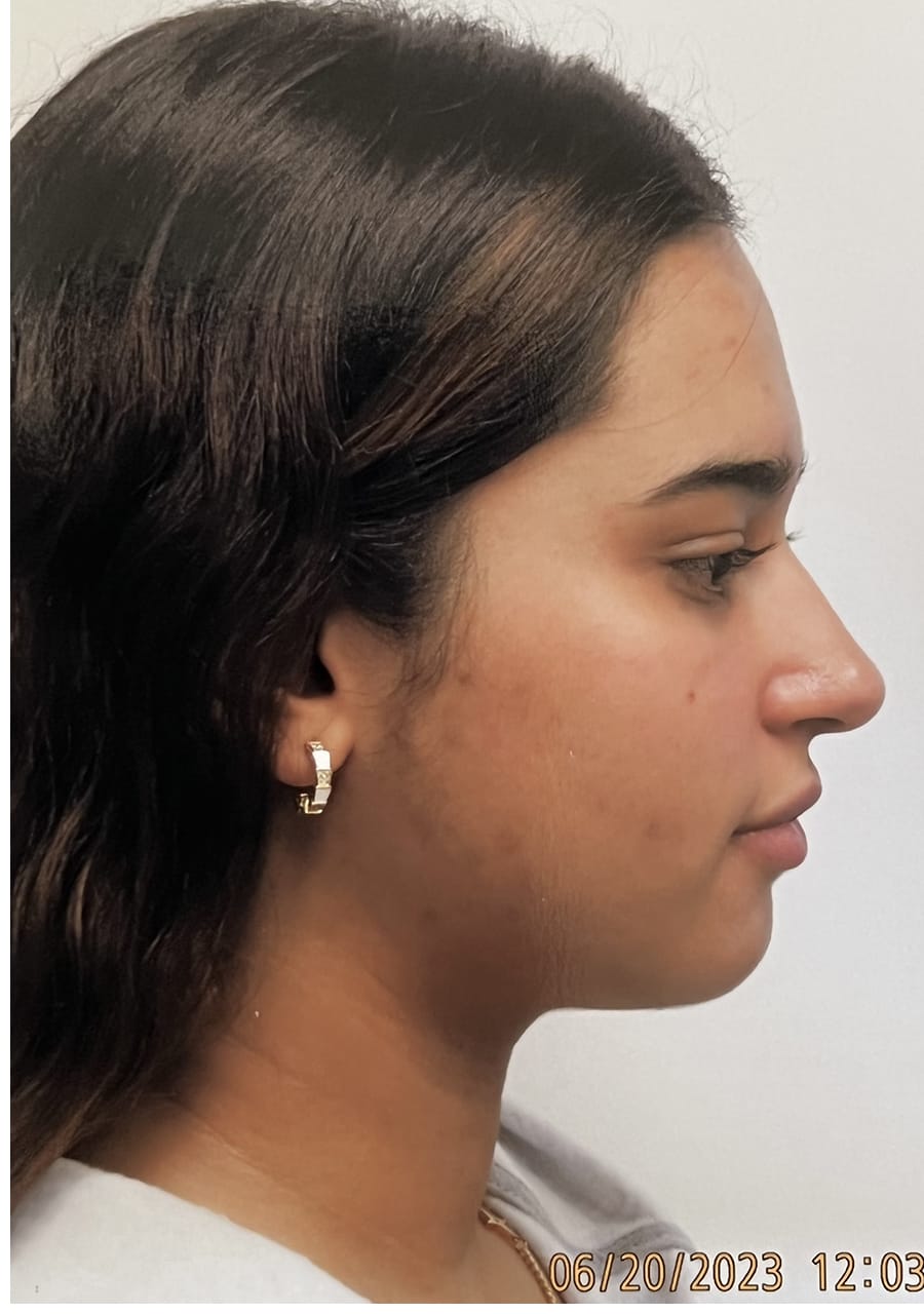 Case Study 154 — before and after