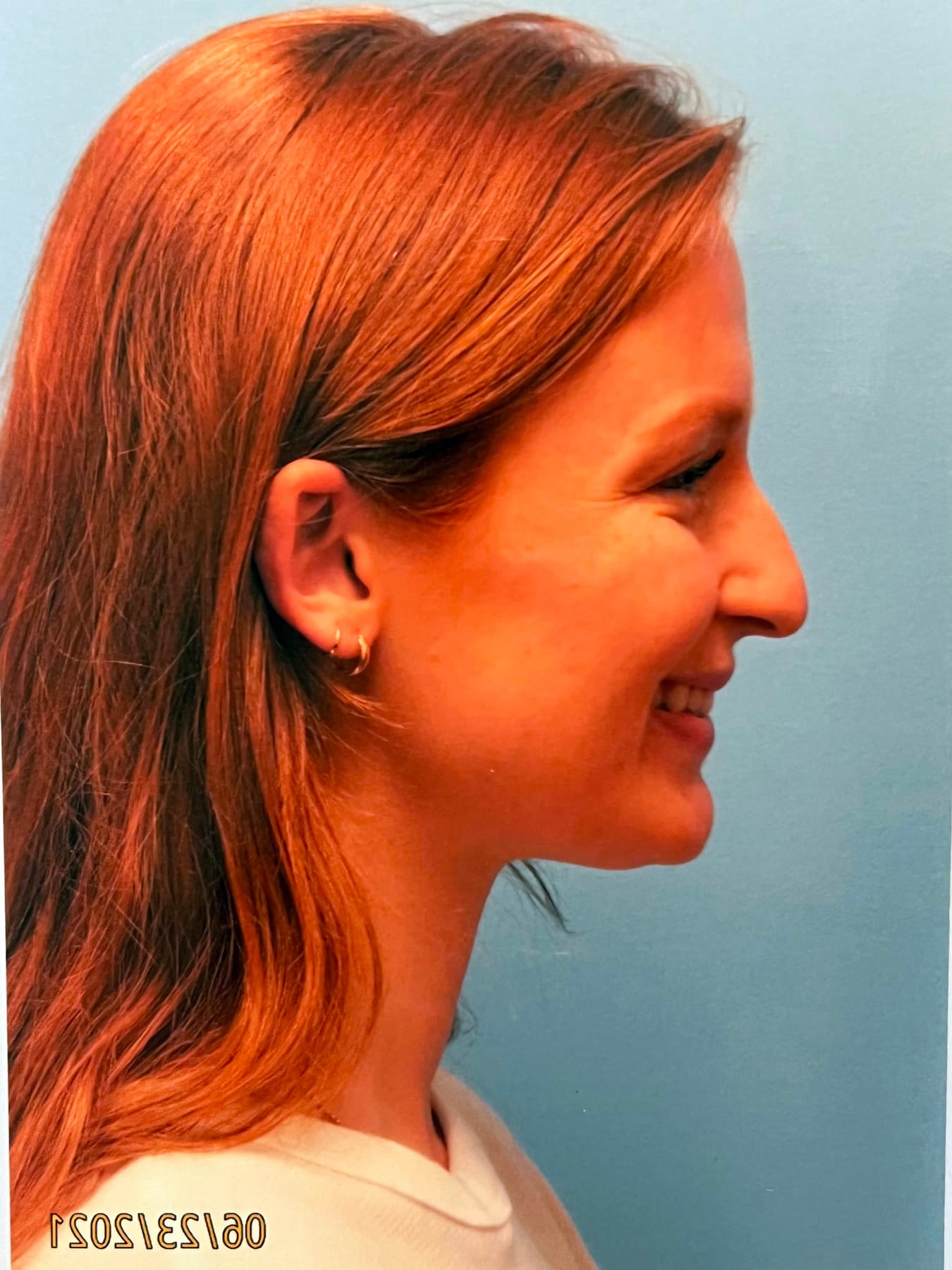 Case Study 47 — before and after