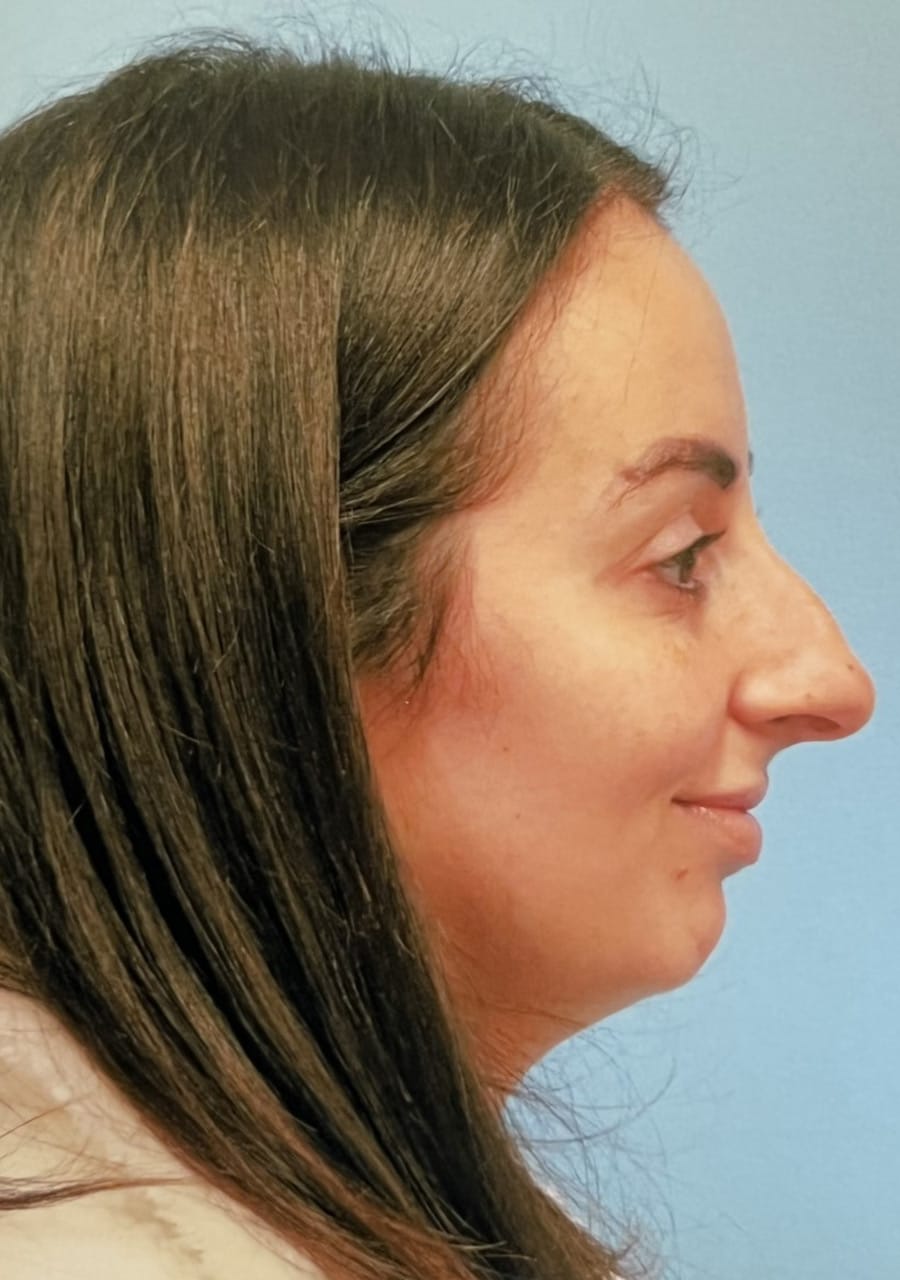 Case Study 90 — before and after