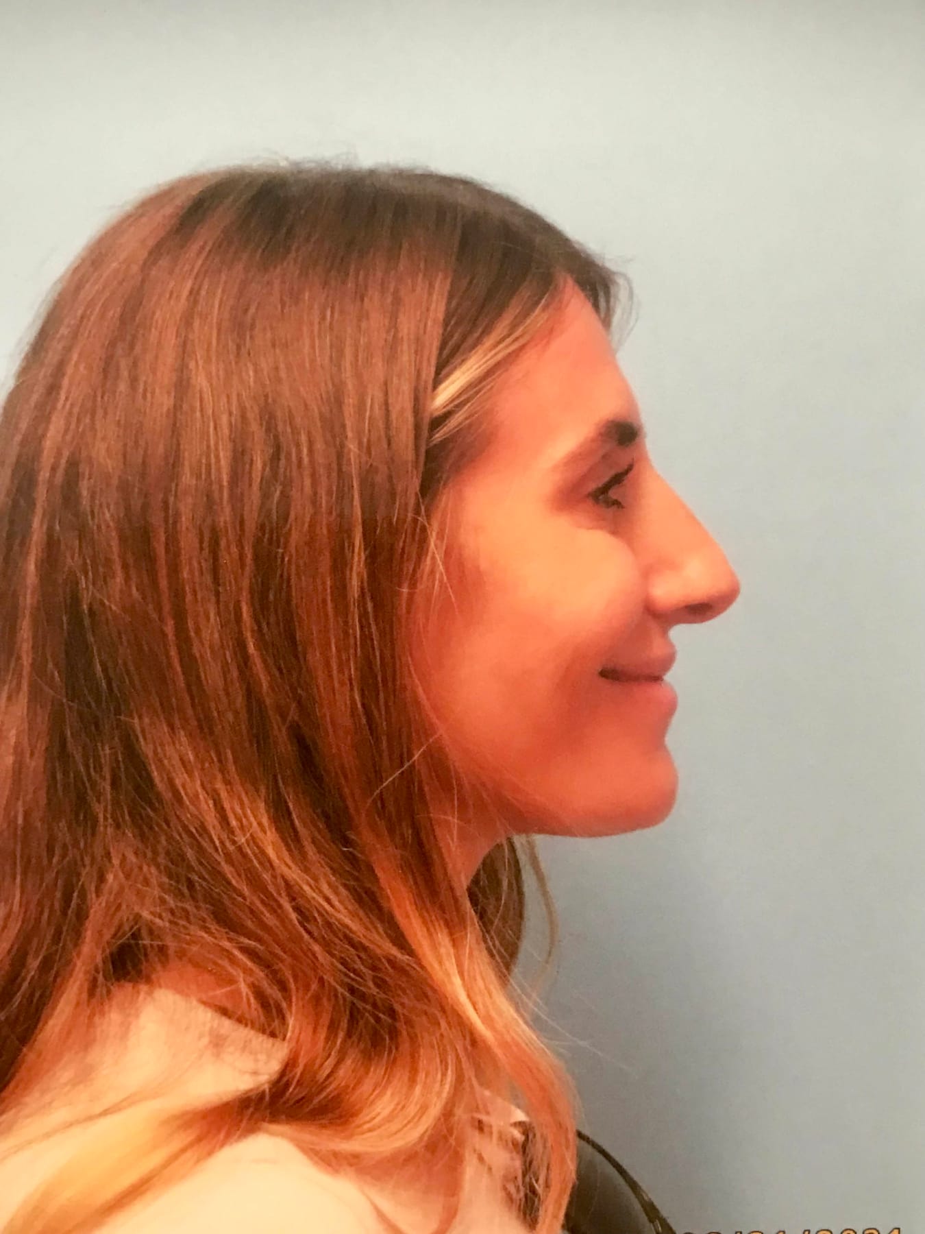 Case Study 33 — before and after