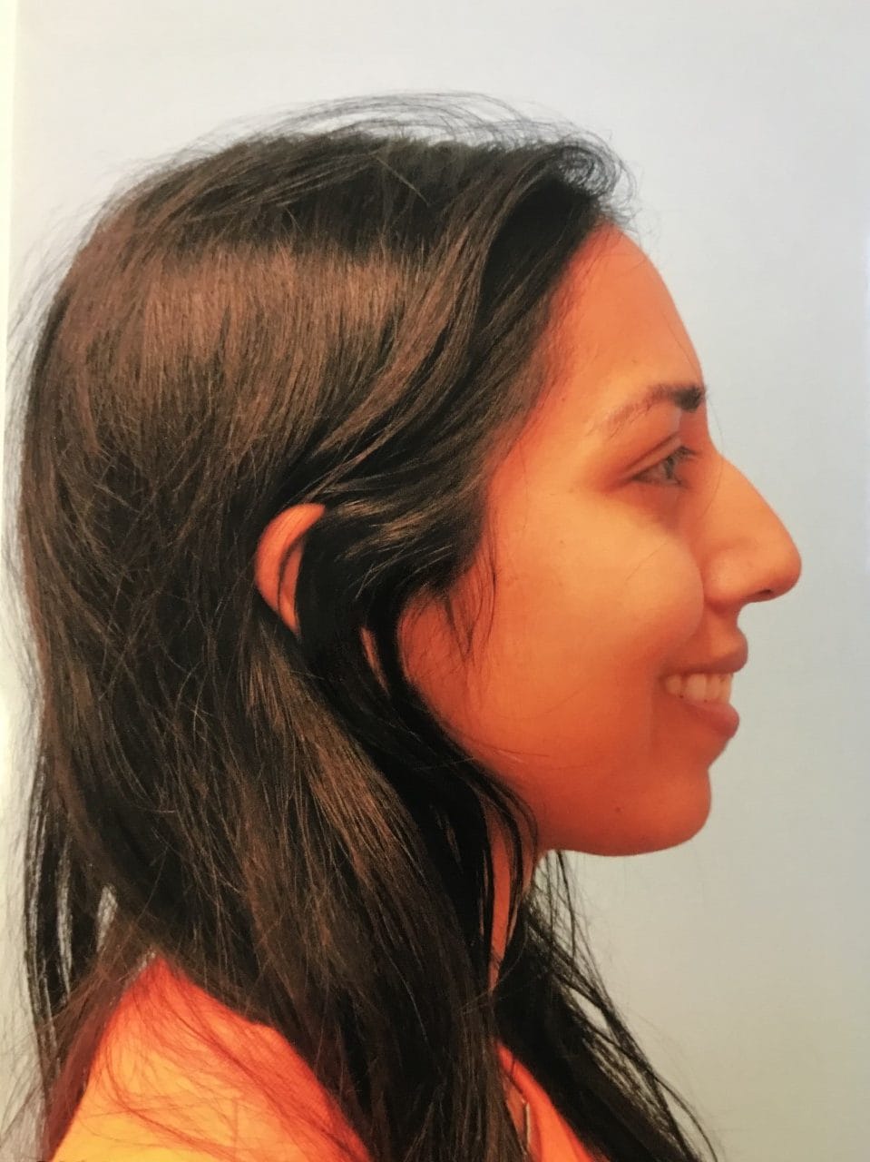 Case Study 11 — before and after
