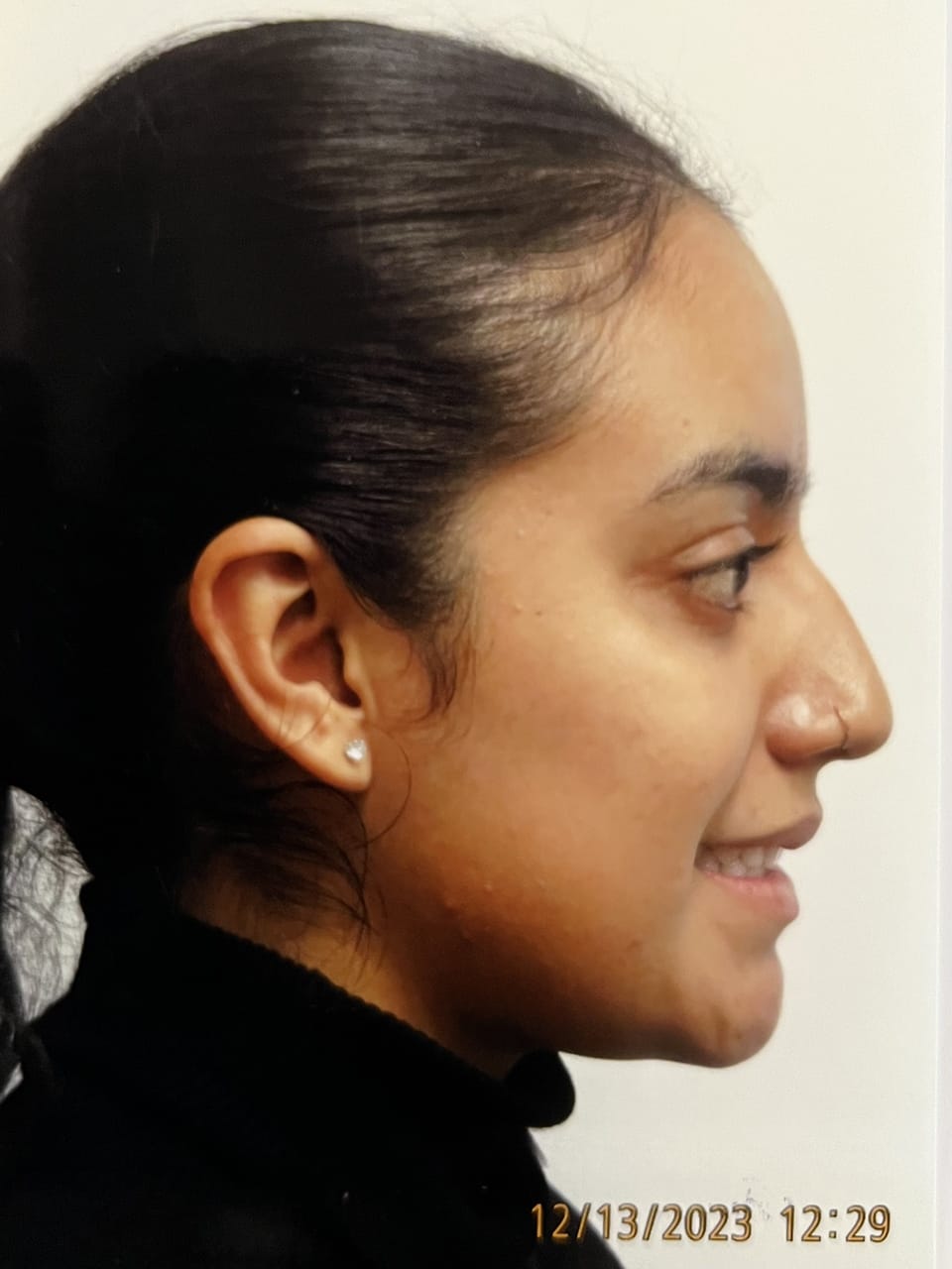 Case Study 246 — before and after