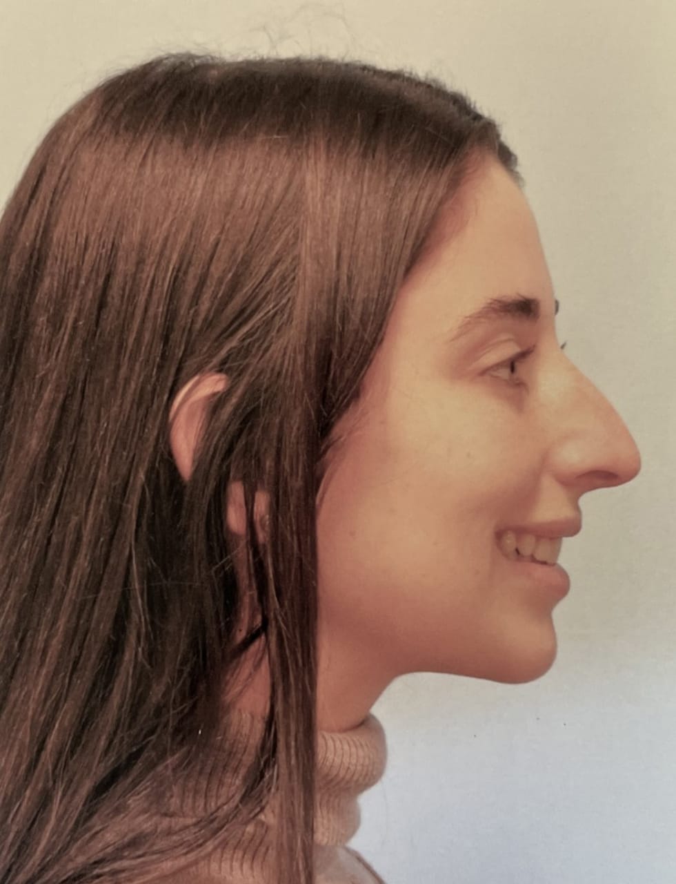 Case Study 61 — before and after