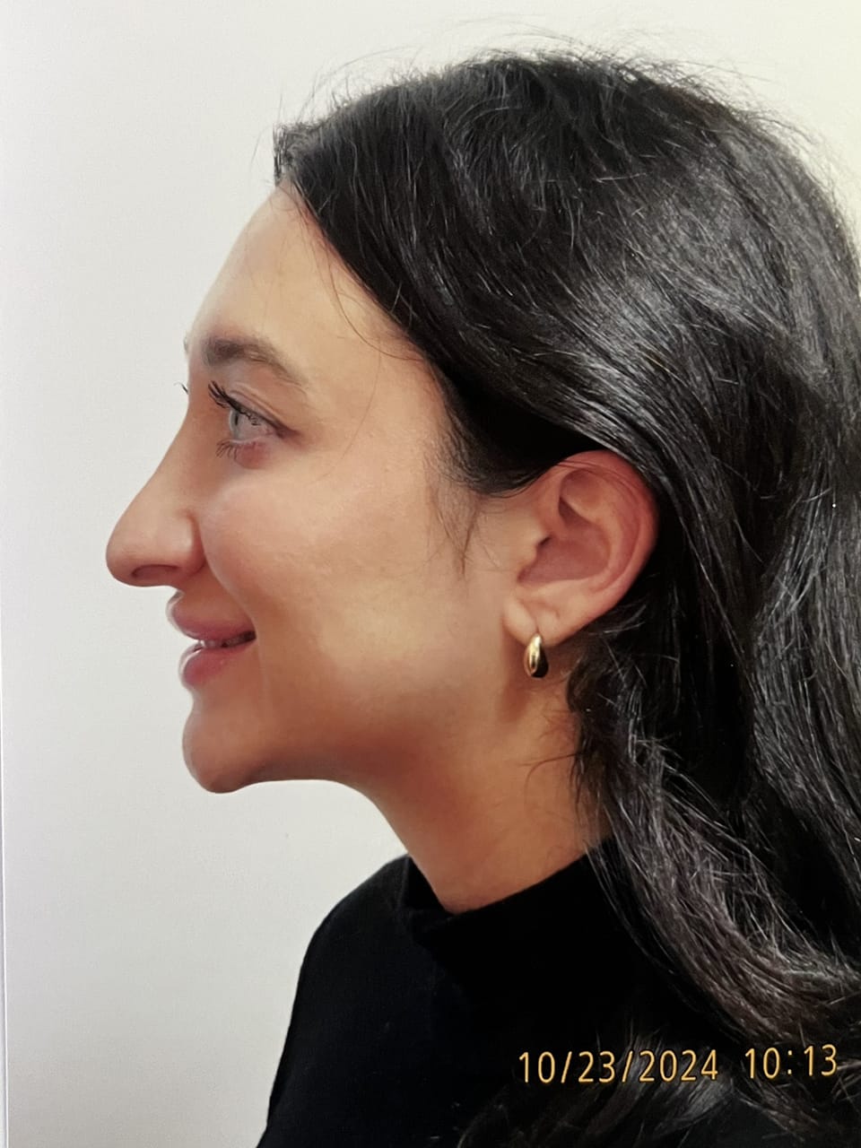 Case Study 255 — before and after