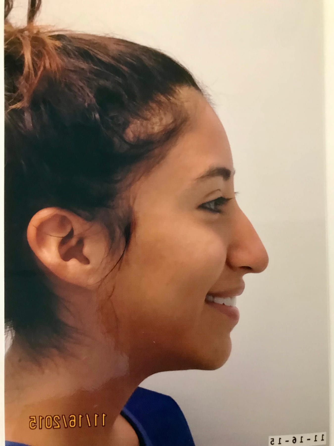 Case Study 17 — before and after
