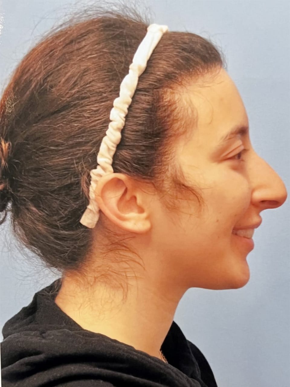 Case Study 51 — before and after