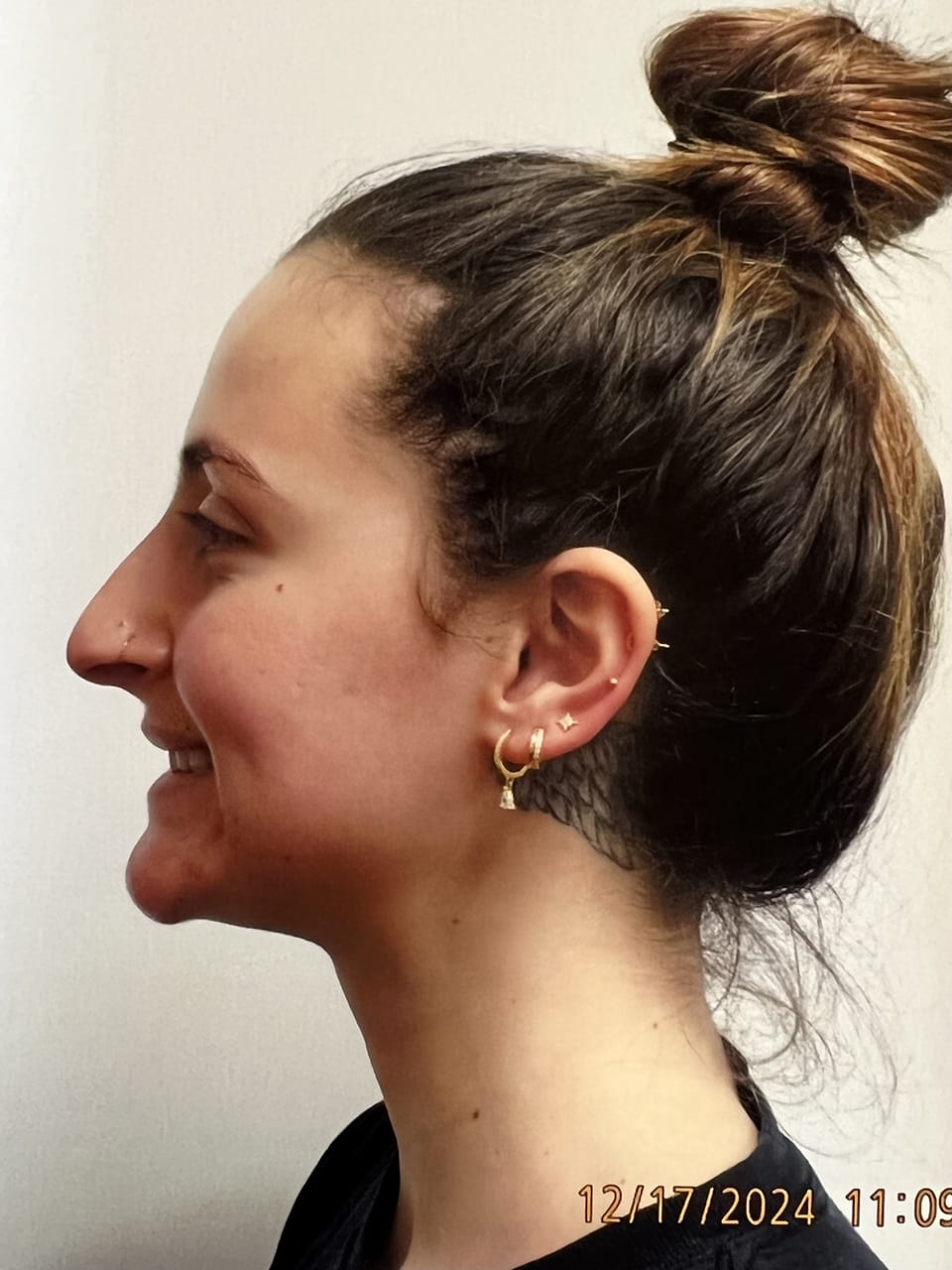 Case Study 253 — before and after