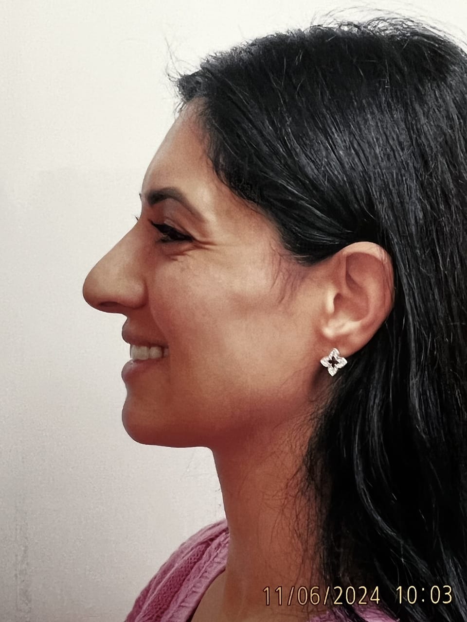 Case Study 242 — before and after