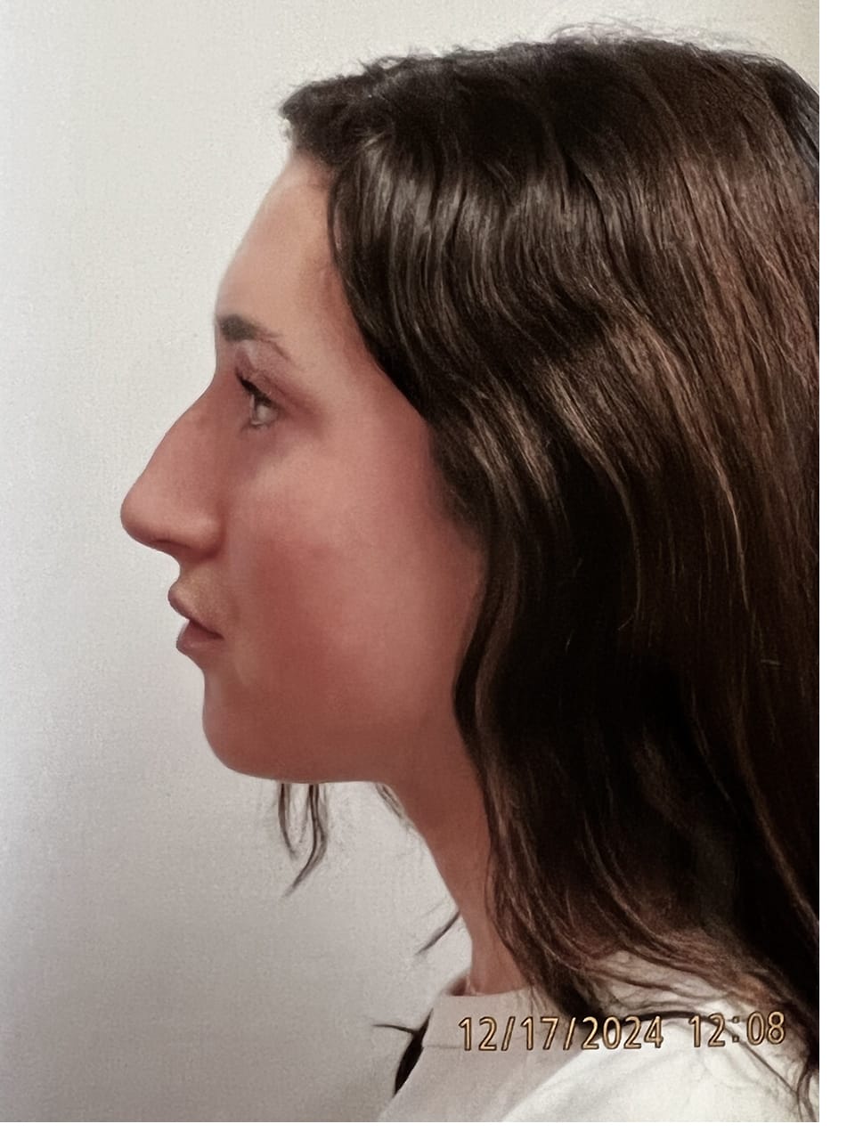 Case Study 252 before