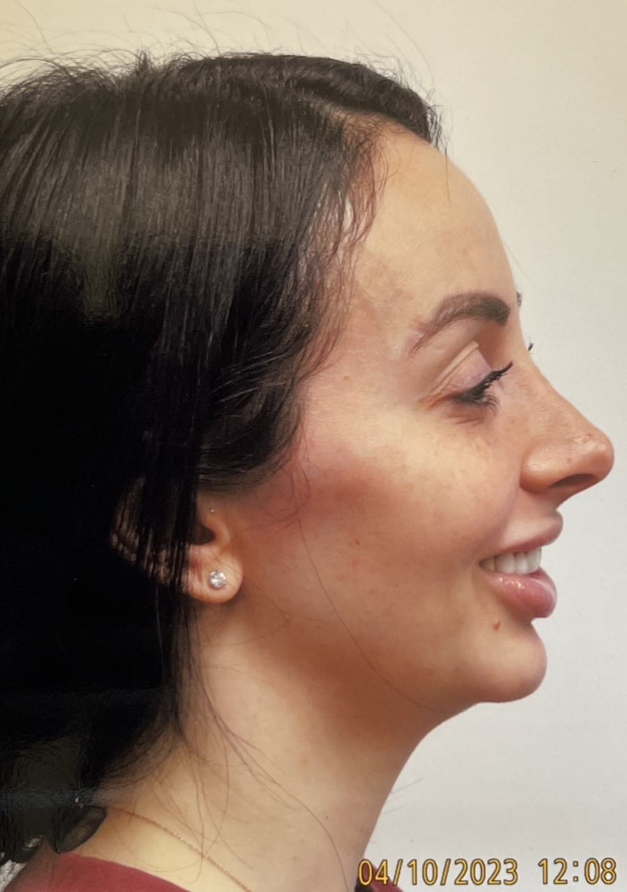Case Study 90 after