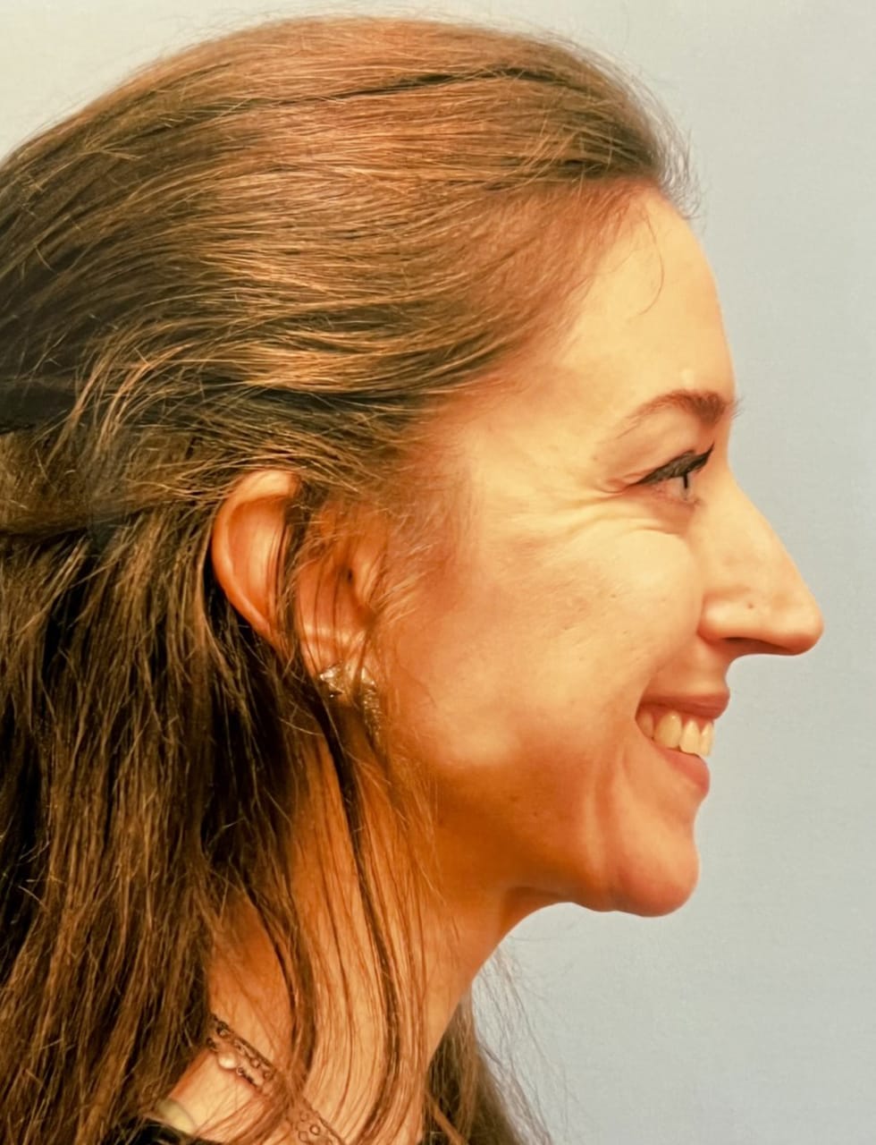 Case Study 52 — before and after
