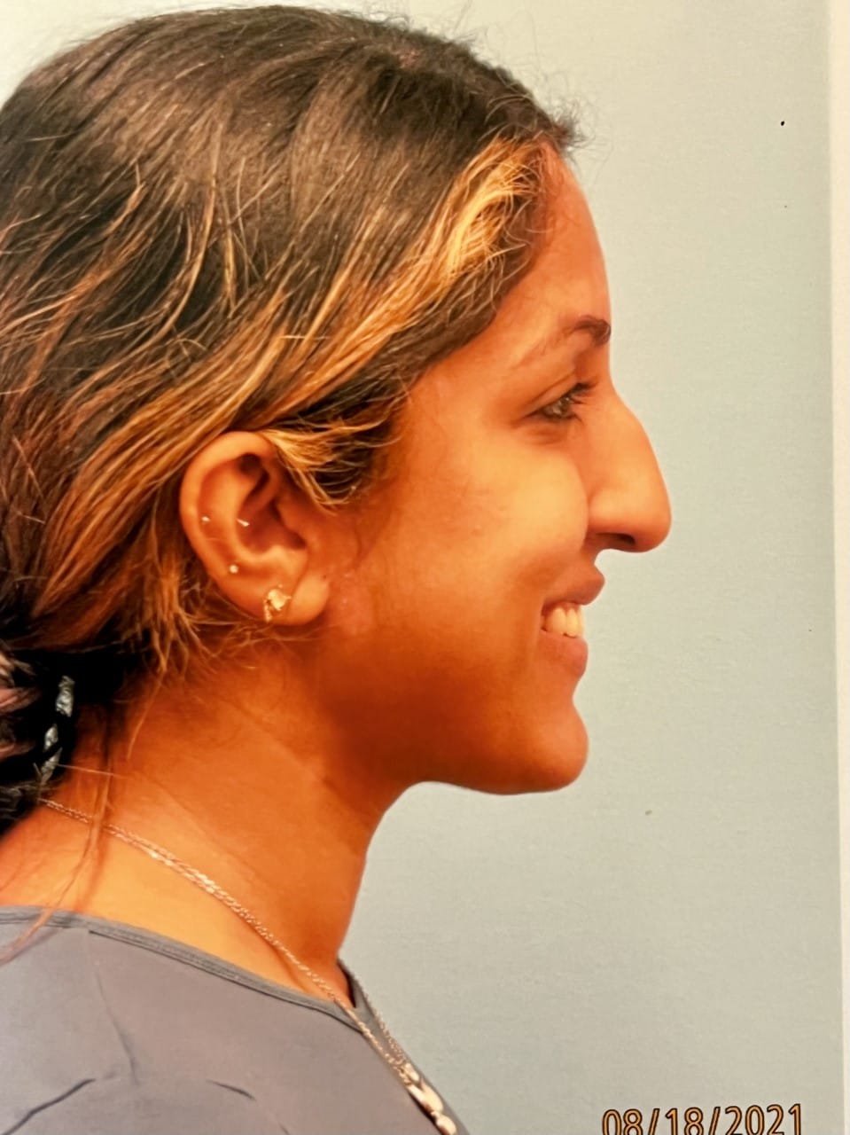 Case Study 56 — before and after