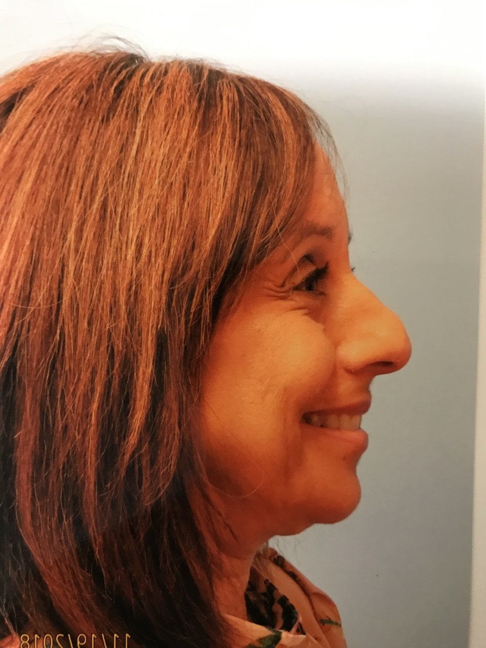 Case Study 13 — before and after