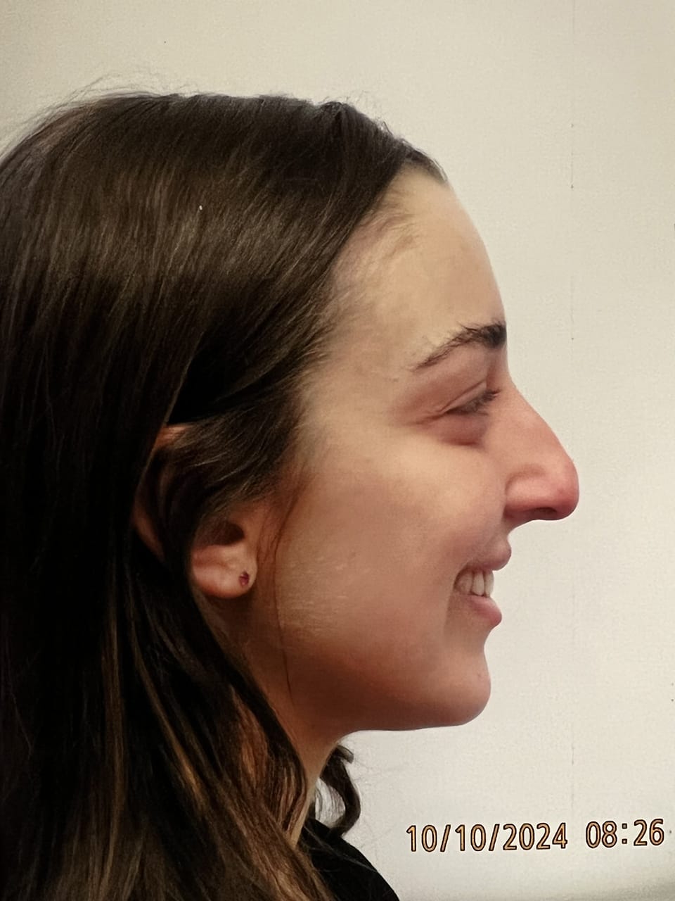 Case Study 240 — before and after