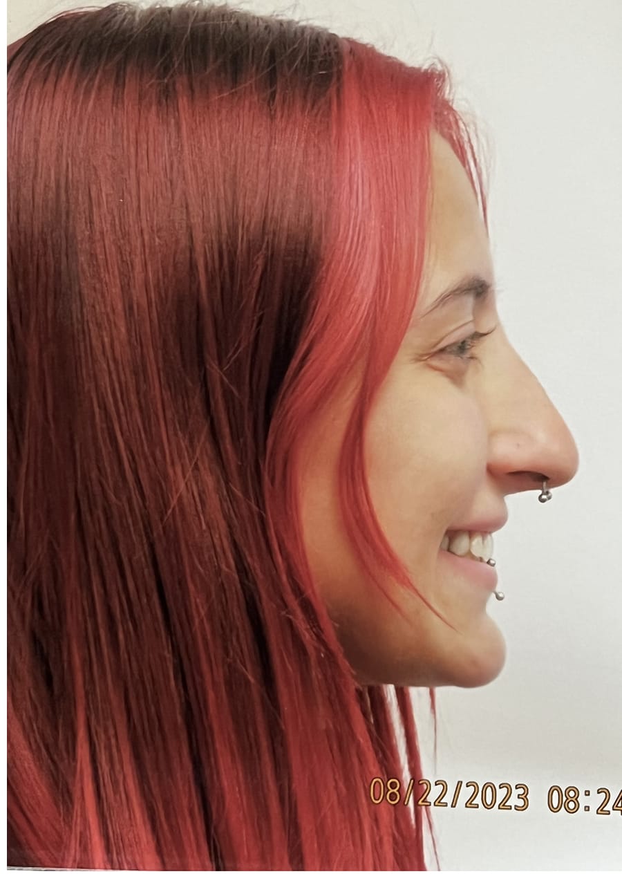 Case Study 152 — before and after