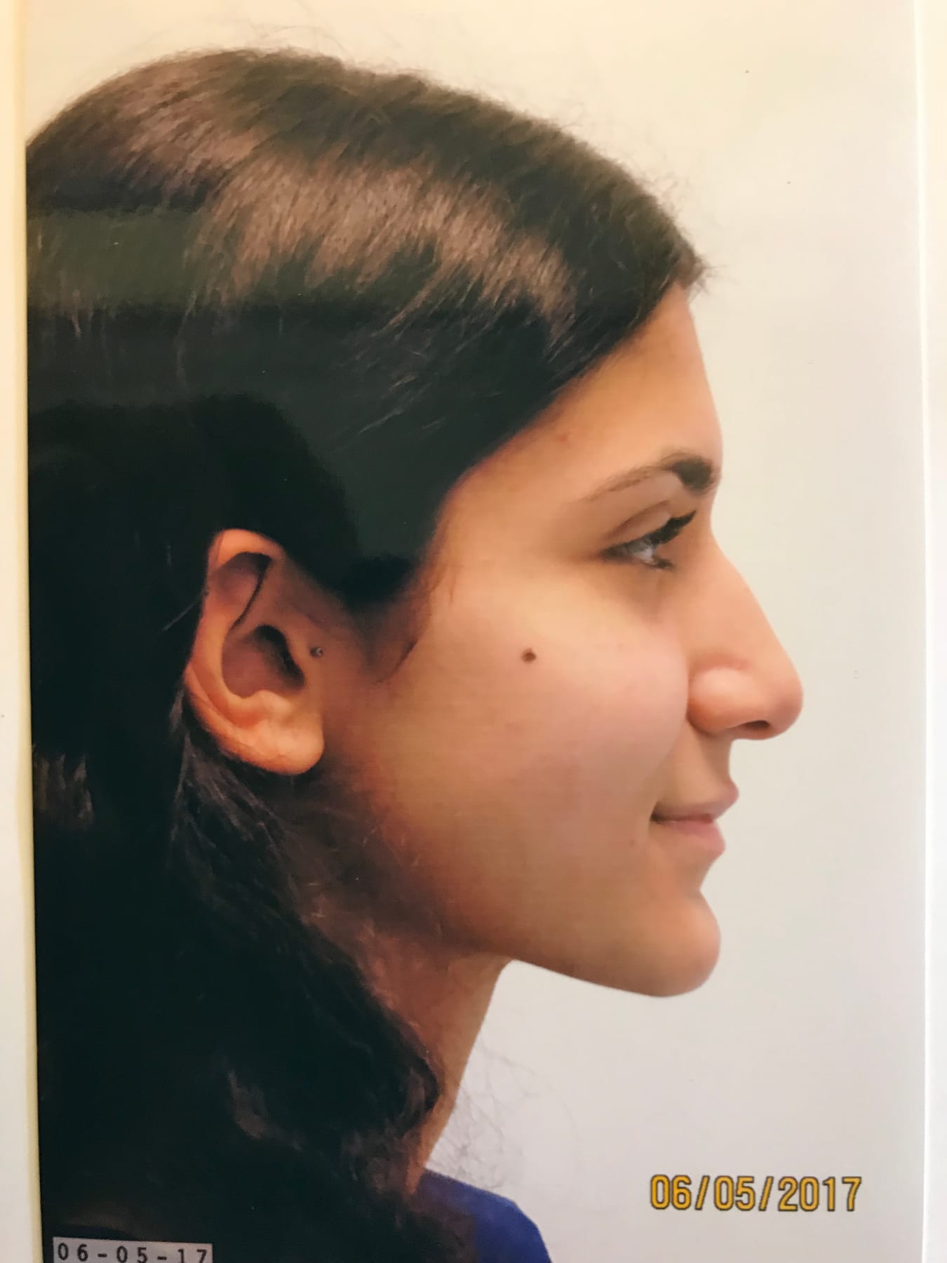 Rhinoplasty patient—view before and after gallery