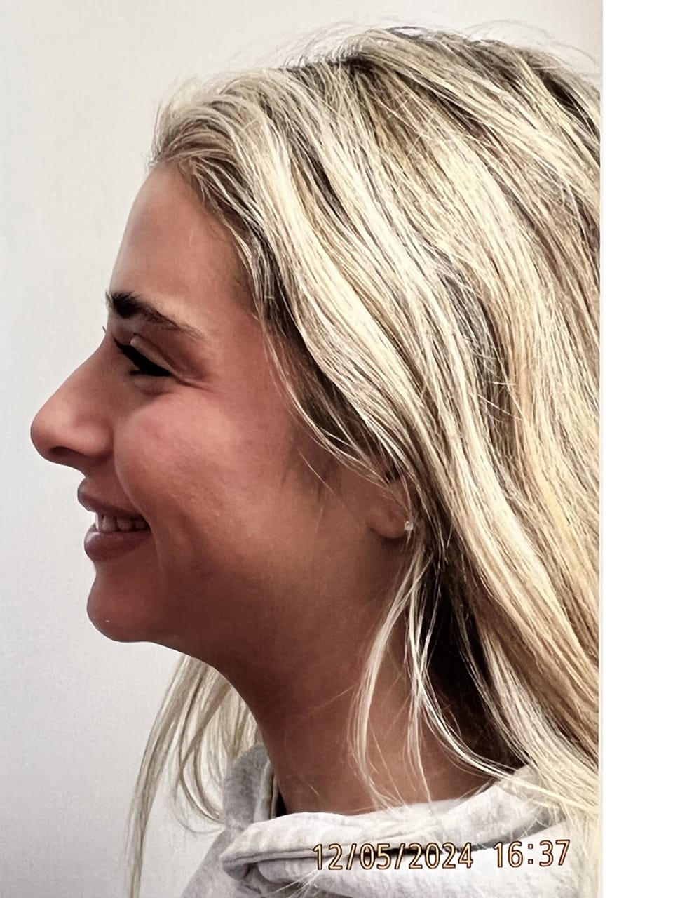 Case Study 254 — before and after