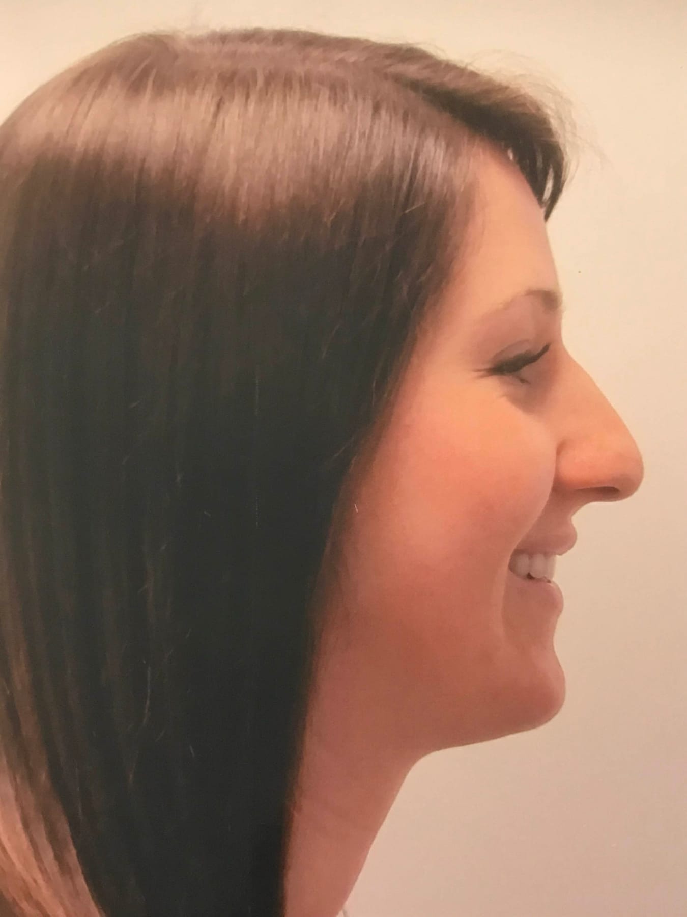 Case Study 32 — before and after